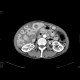Carcinoid metastatses in the liver: CT - Computed tomography